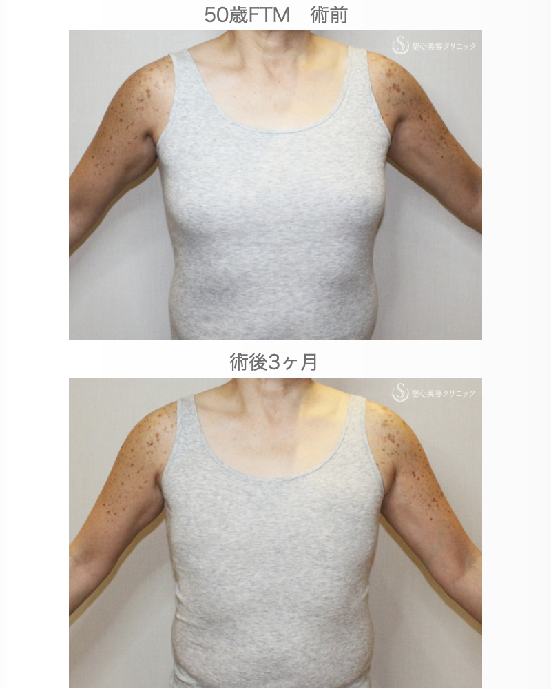 【50歳FTM・「性同一性障害」男らしい胸に】乳腺切除＋脂肪吸引（術直後〜3ヶ月後） After 