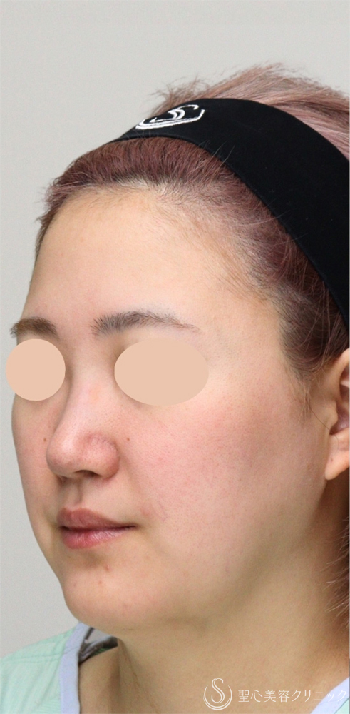 【20代女性・輪郭骨切り】オトガイ形成（下顎短縮）＋隆鼻プロテーゼ＋小鼻縮小術（1ヶ月後） Before 
