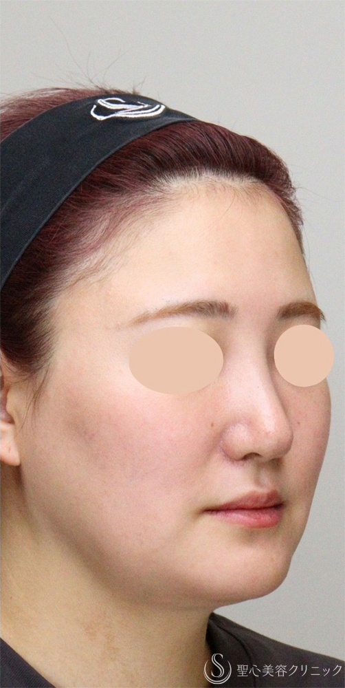 【20代女性・輪郭骨切り】オトガイ形成（下顎短縮）＋隆鼻プロテーゼ＋小鼻縮小術（1ヶ月後） After 