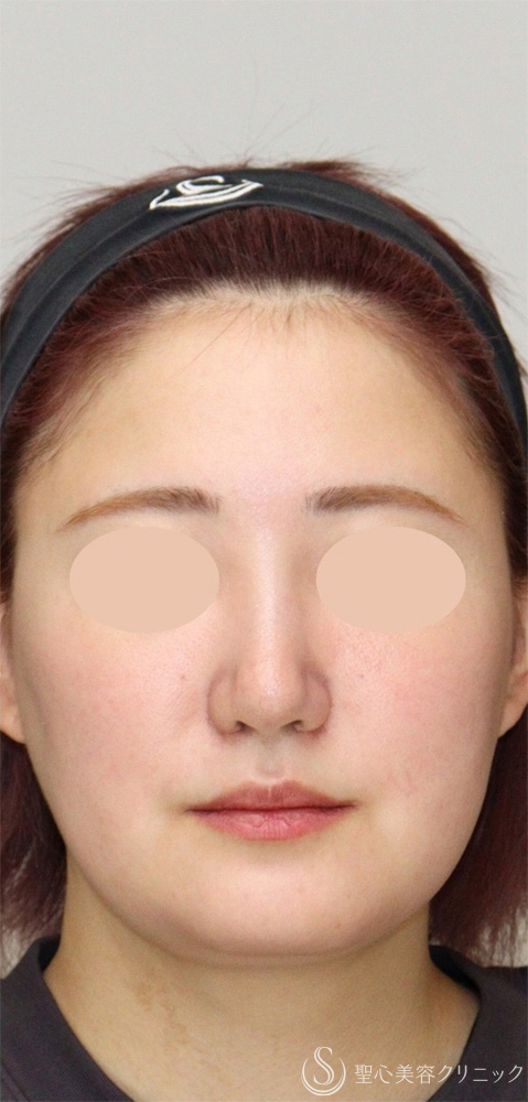 【20代女性・輪郭骨切り】オトガイ形成（下顎短縮）＋隆鼻プロテーゼ＋小鼻縮小術（1ヶ月後） After 