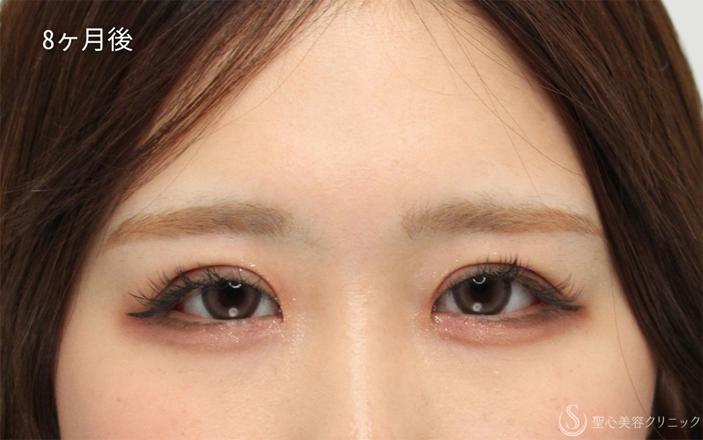 【20代女性・切開法で華やか二重】二重術（切開法）部分切開／全切開（8ヶ月後） After 