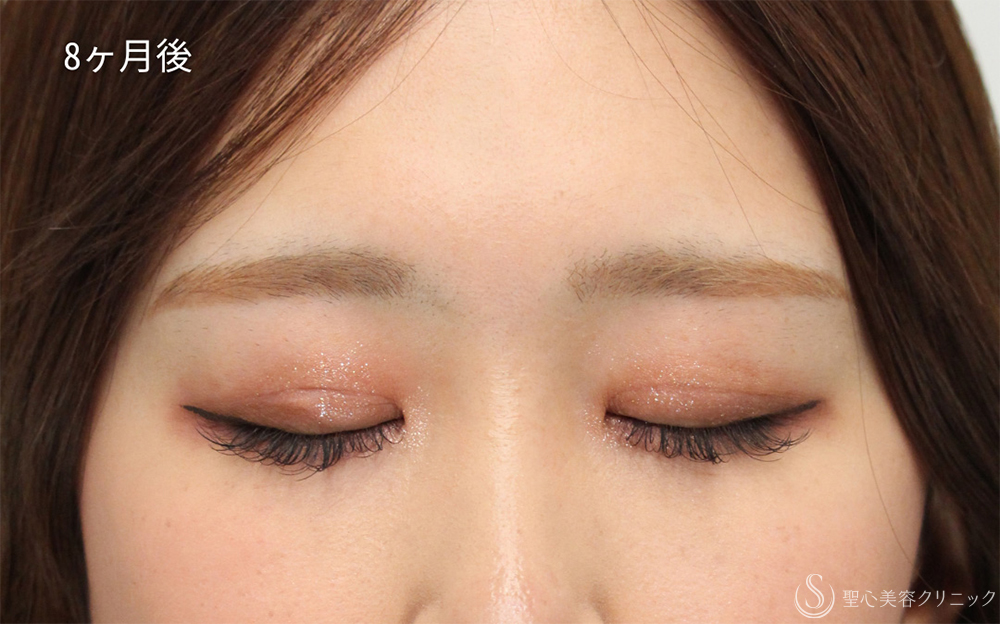 【20代女性・切開法で華やか二重】二重術（切開法）部分切開／全切開（8ヶ月後） After 