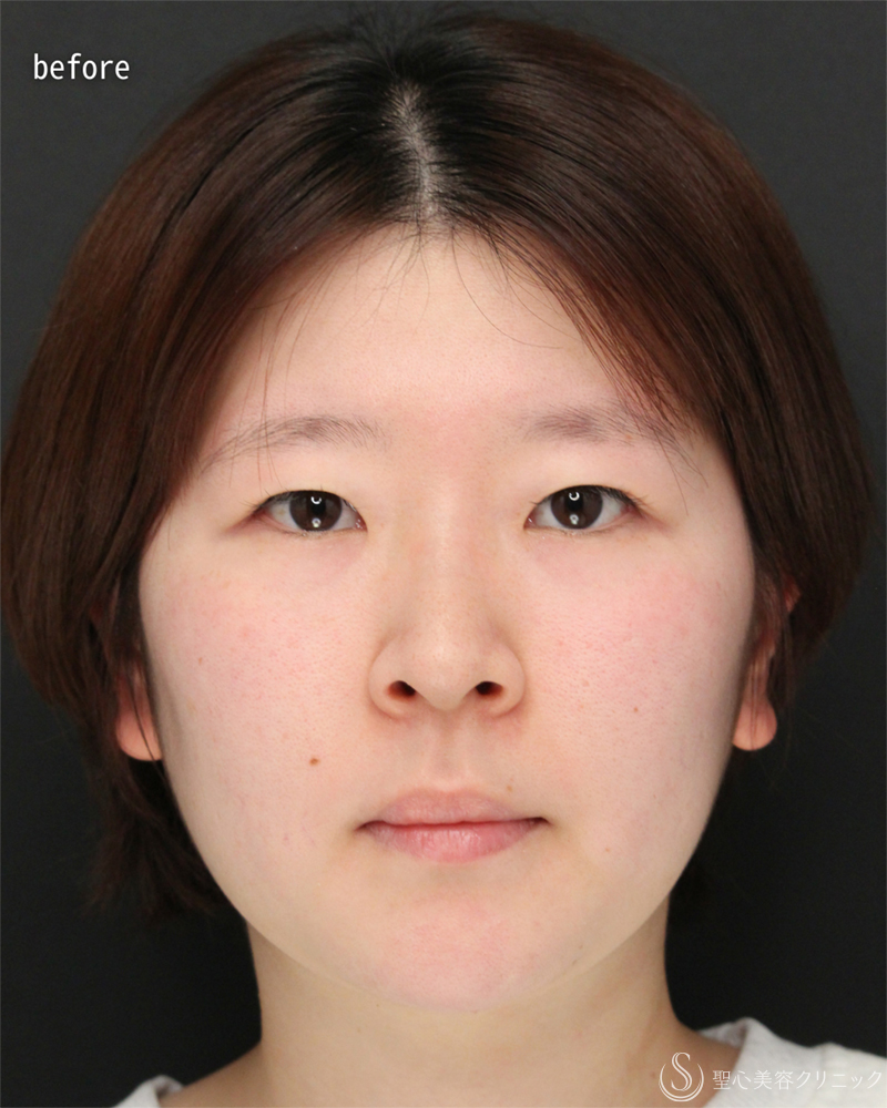【20代女性・取れない華やかな二重に】二重切開術（3ヶ月後） Before 