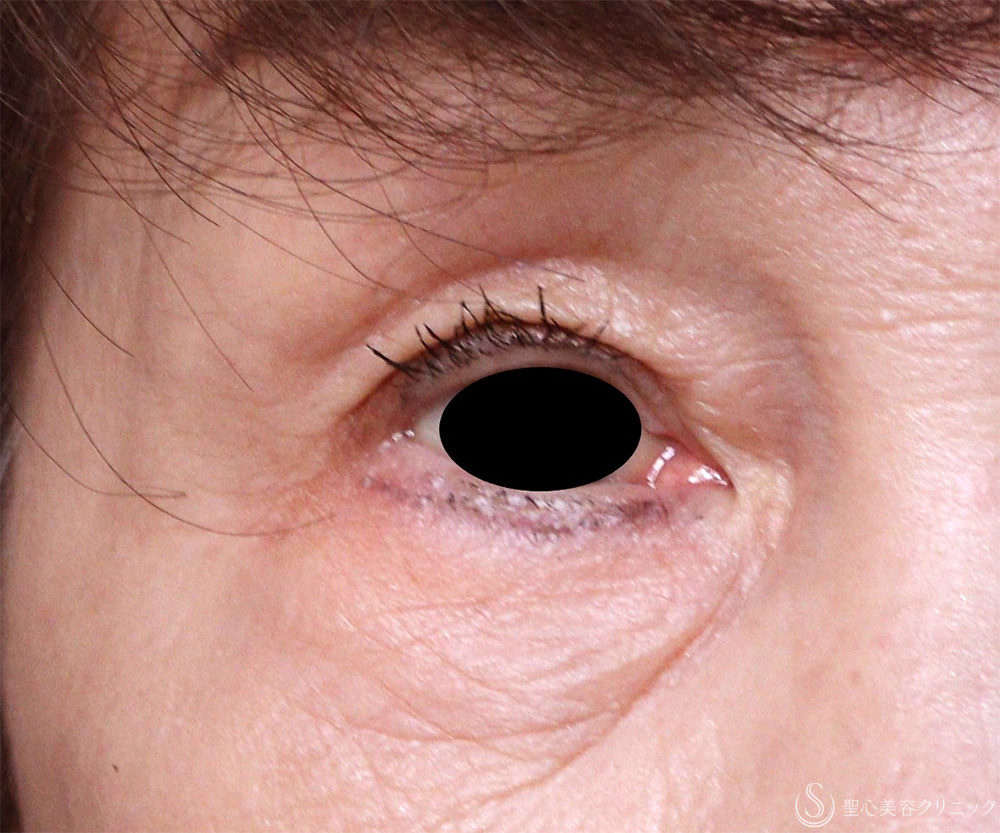 【70代女性・目の上のたるみ】重瞼線部切開法（3ヶ月後） After 