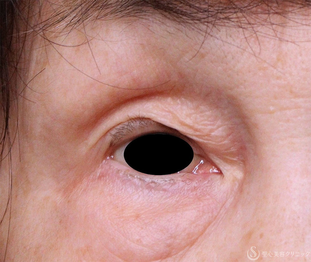 【70代女性・目の上のたるみ】重瞼線部切開法（3ヶ月後） Before 