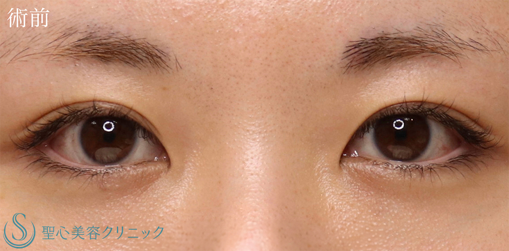 【20代女性・寄り目にさせず蒙古襞を解除したい！！】目上切開（1.5ヶ月後） Before 