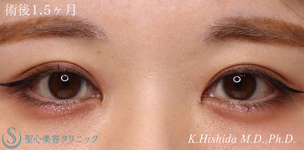 【20代女性・寄り目にさせず蒙古襞を解除したい！！】目上切開（1.5ヶ月後） After 