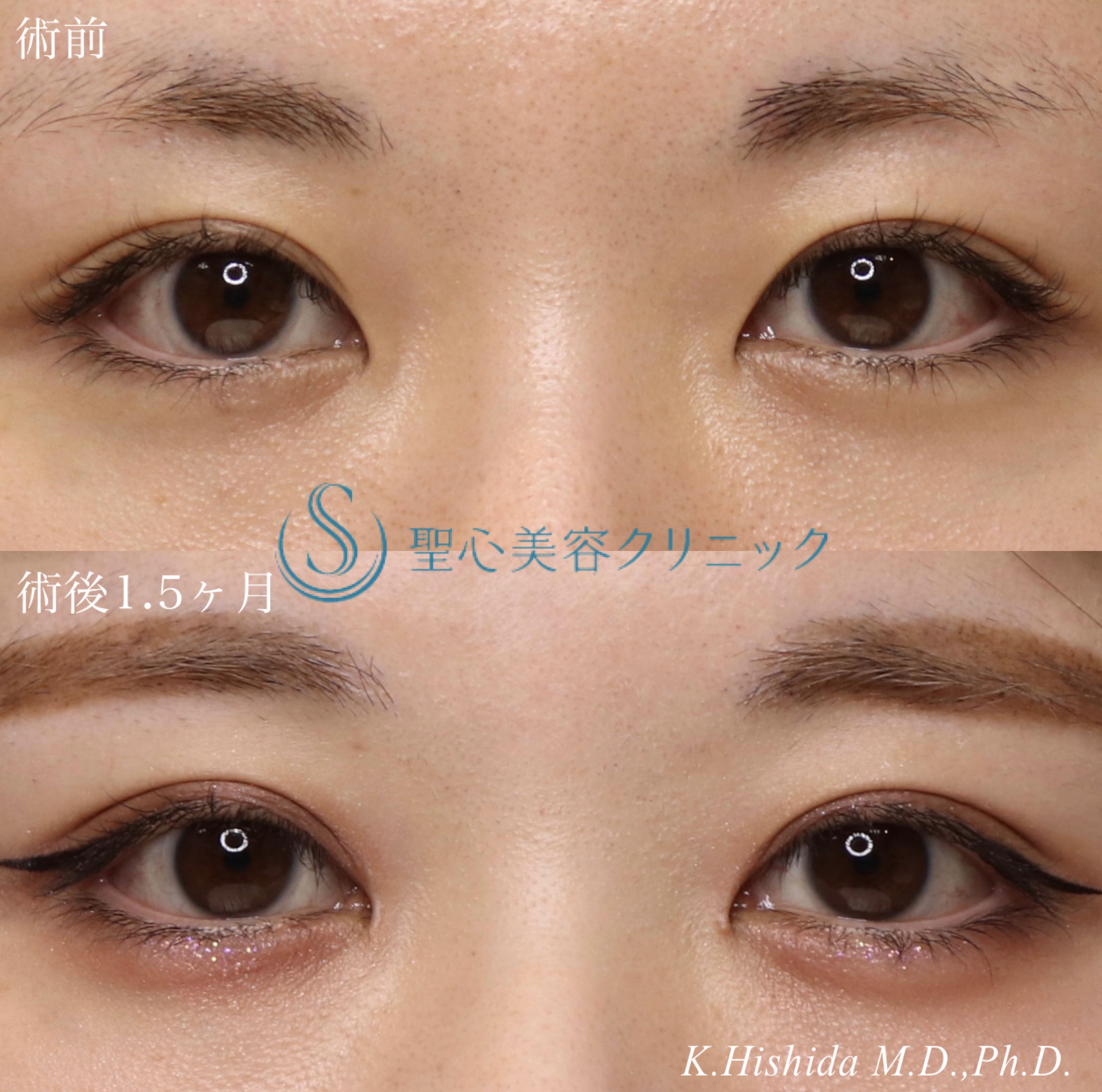 【20代女性・寄り目にさせず蒙古襞を解除したい！！】目上切開（1.5ヶ月後） After 