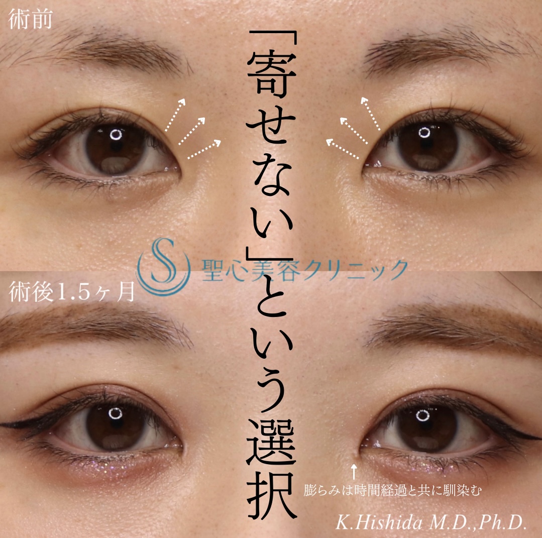 【20代女性・寄り目にさせず蒙古襞を解除したい！！】目上切開（1.5ヶ月後） After 
