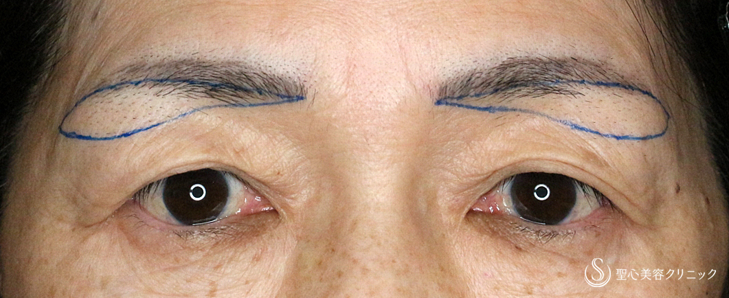 【60代女性・目元の整形ではなく若返り】眉下リフト+α「Ver.2」（術直後〜1ヶ月後） Before 