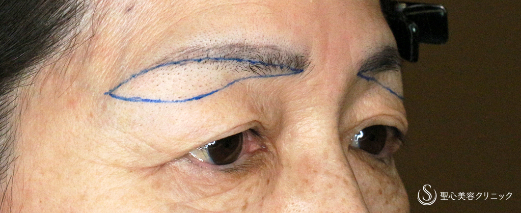 【60代女性・目元の整形ではなく若返り】眉下リフト+α「Ver.2」（術直後〜1ヶ月後） Before 