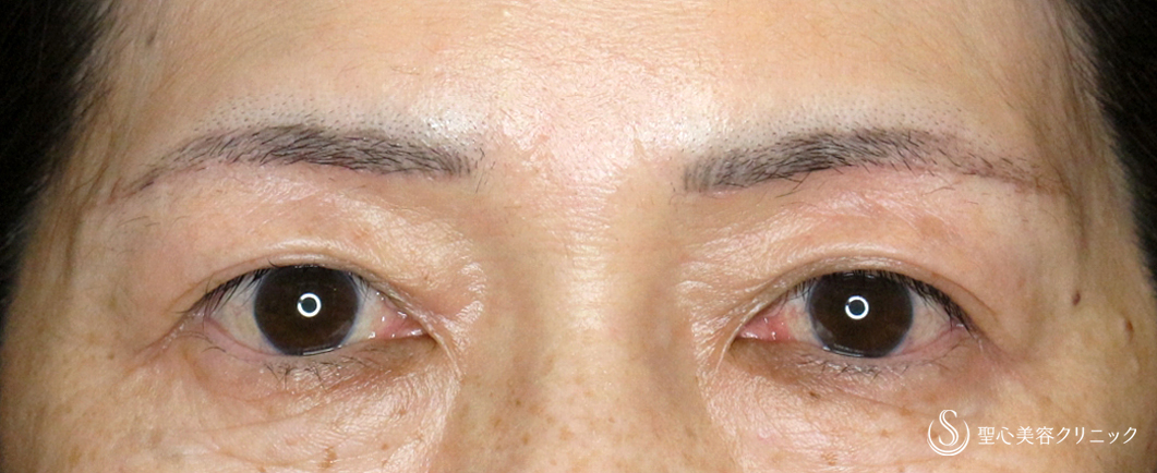 【60代女性・目元の整形ではなく若返り】眉下リフト+α「Ver.2」（術直後〜1ヶ月後） After 