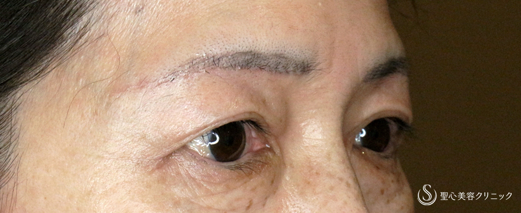 【60代女性・目元の整形ではなく若返り】眉下リフト+α「Ver.2」（術直後〜1ヶ月後） After 