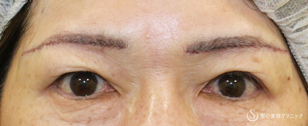 【60代女性・目元の整形ではなく若返り】眉下リフト+α「Ver.2」（術直後〜1ヶ月後） Before 