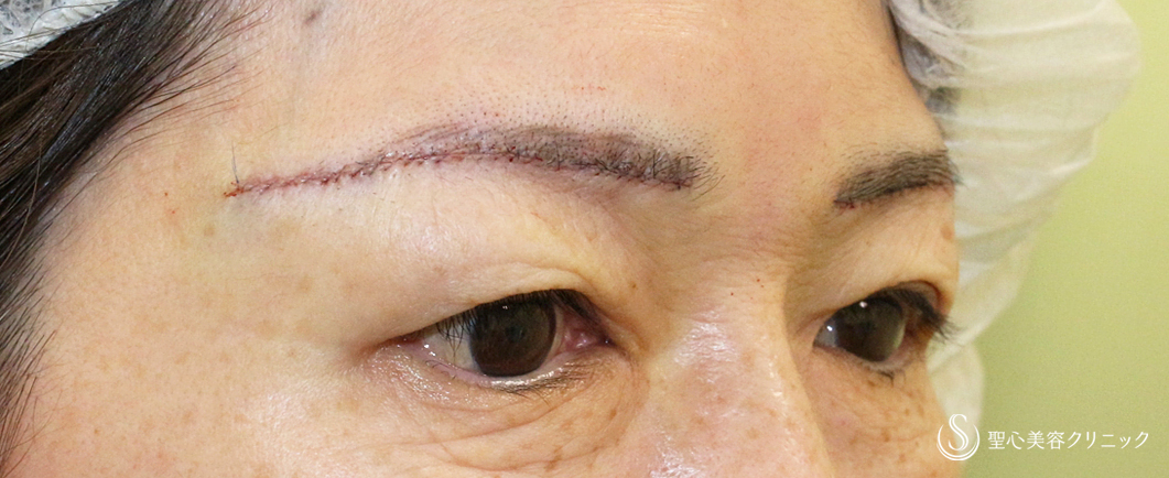 【60代女性・目元の整形ではなく若返り】眉下リフト+α「Ver.2」（術直後〜1ヶ月後） Before 
