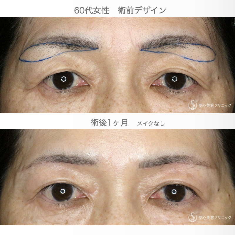 【60代女性・目元の整形ではなく若返り】眉下リフト+α「Ver.2」（術直後〜1ヶ月後） After 