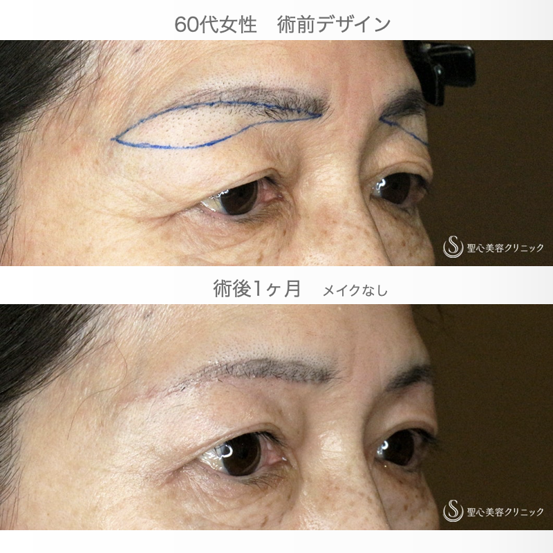 【60代女性・目元の整形ではなく若返り】眉下リフト+α「Ver.2」（術直後〜1ヶ月後） After 