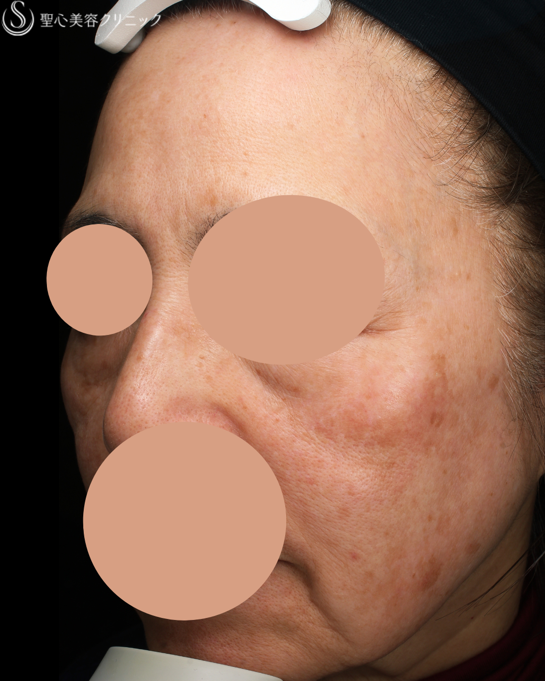 【60代女性・シミシワ】セレックV1回照射＋レチノール外用＋トラネキサム酸内服（1ヶ月後） Before 