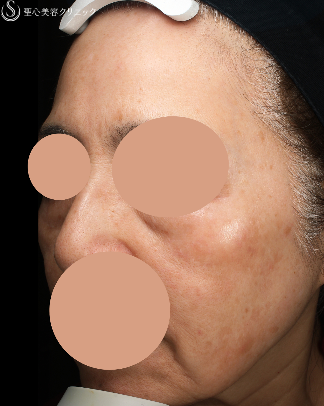 【60代女性・シミシワ】セレックV1回照射＋レチノール外用＋トラネキサム酸内服（1ヶ月後） After 