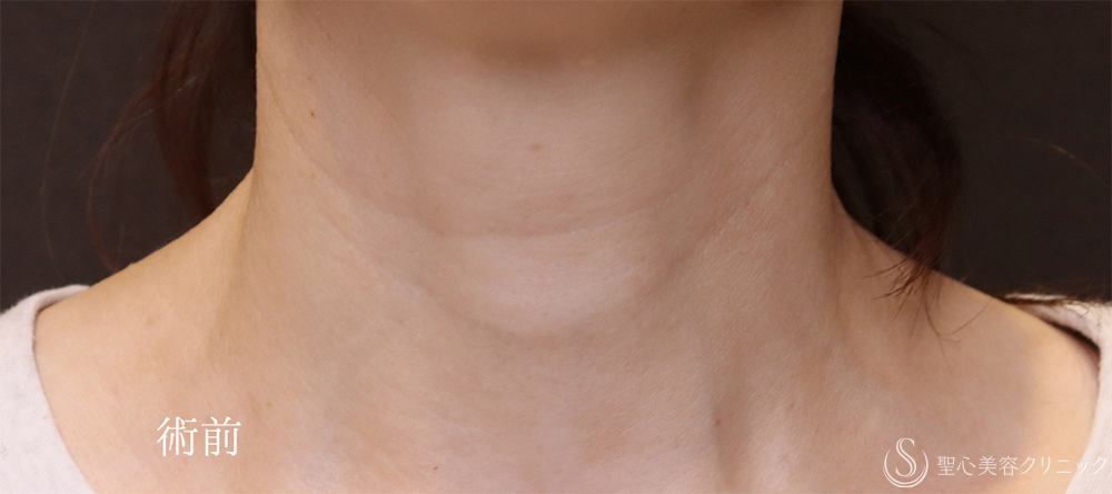 【40代女性・首のしわをPRPで目立ちにくく】プレミアムPRP皮膚再生療法（9ヶ月後） Before 