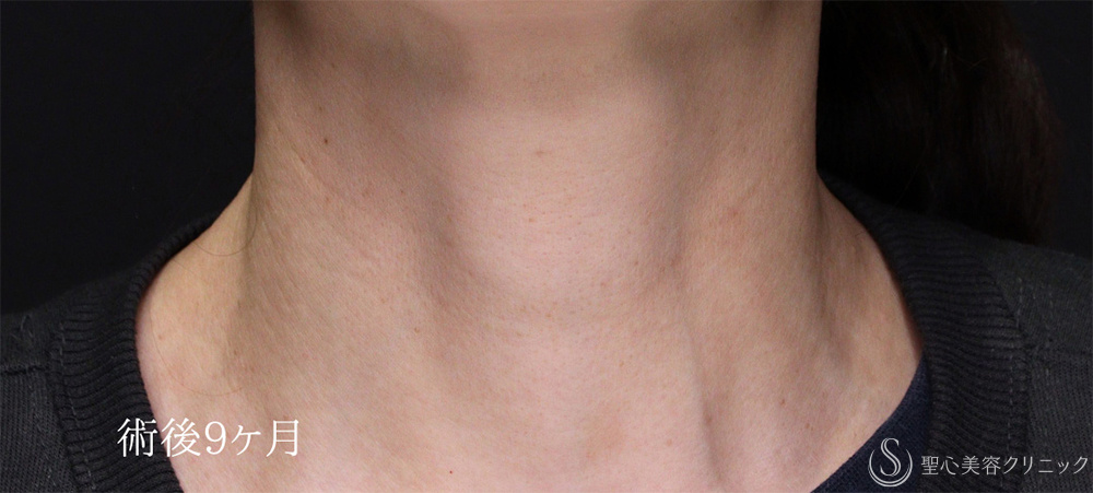 【40代女性・首のしわをPRPで目立ちにくく】プレミアムPRP皮膚再生療法（9ヶ月後） After 