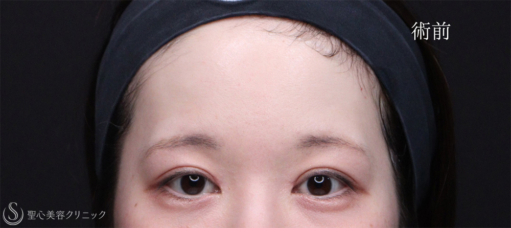 【30代女性・PRPで額を丸く仕上げる】プレミアムPRP皮膚再生療法（3ヶ月後） Before 