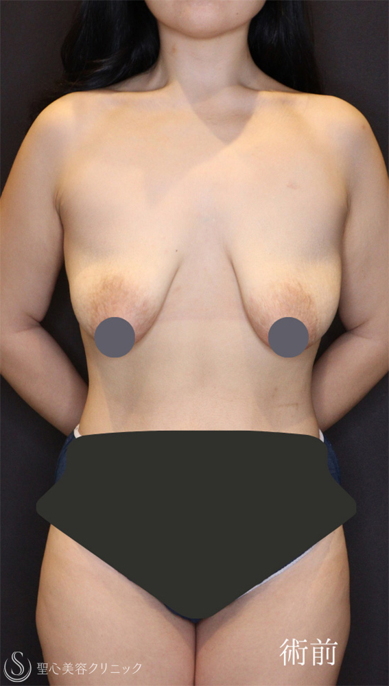 【20代女性・バストの下垂を修正】 乳房吊り上げ術（マストペクシー）（1ヶ月後） Before 