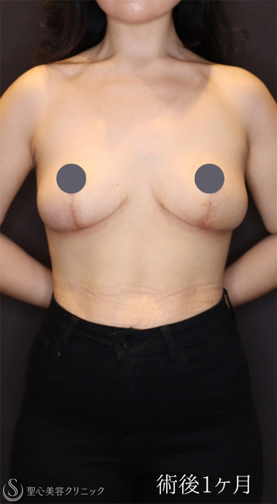 【20代女性・バストの下垂を修正】 乳房吊り上げ術（マストペクシー）（1ヶ月後） After 