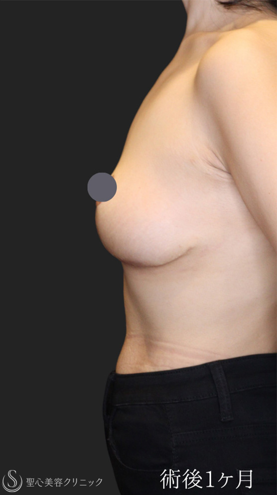 【20代女性・バストの下垂を修正】 乳房吊り上げ術（マストペクシー）（1ヶ月後） After 
