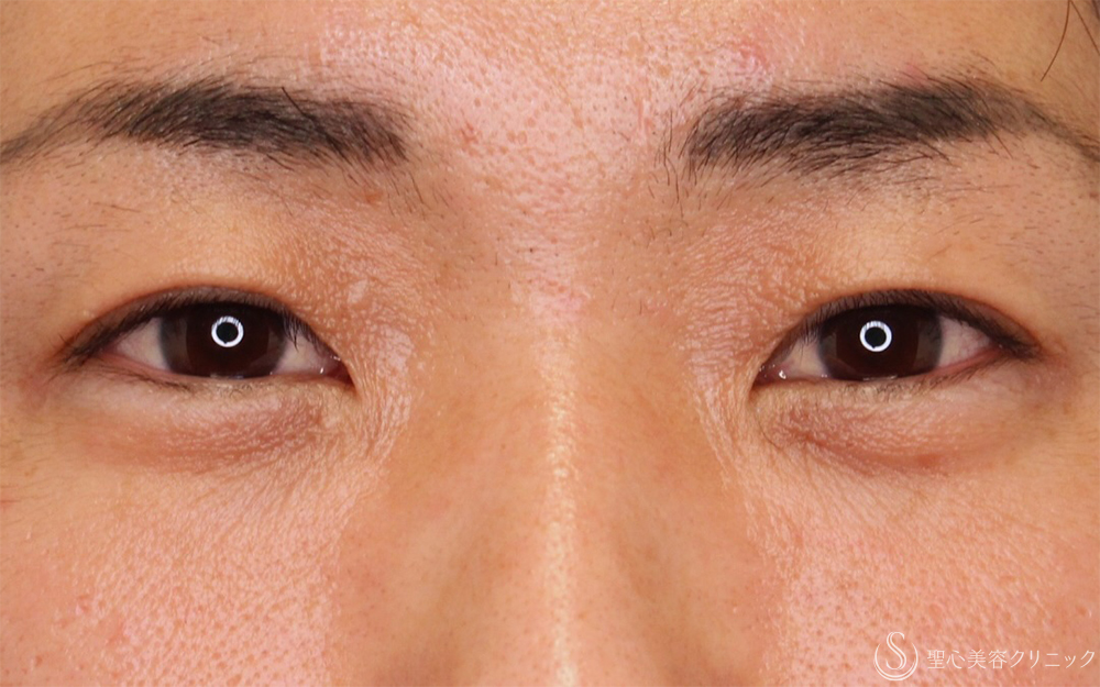【30代男性・自然な二重に】二重埋没法：ダブルノット法（1ヶ月後） After 