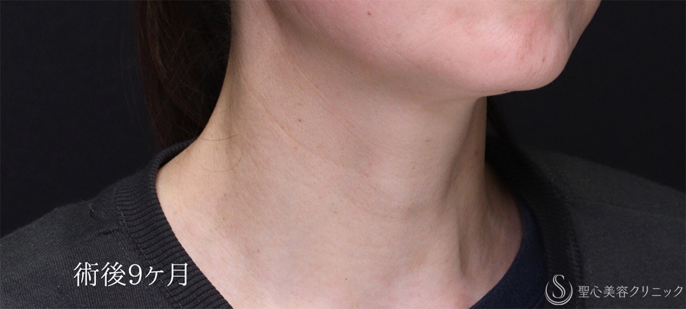 【40代女性・首のしわをPRPで目立ちにくく】プレミアムPRP皮膚再生療法（9ヶ月後） After 