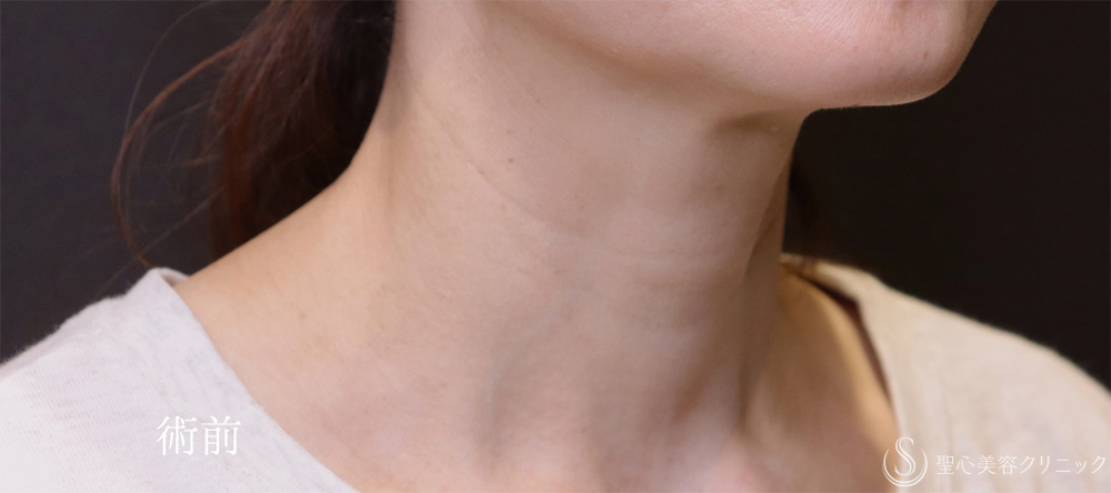 【40代女性・首のしわをPRPで目立ちにくく】プレミアムPRP皮膚再生療法（9ヶ月後） Before 