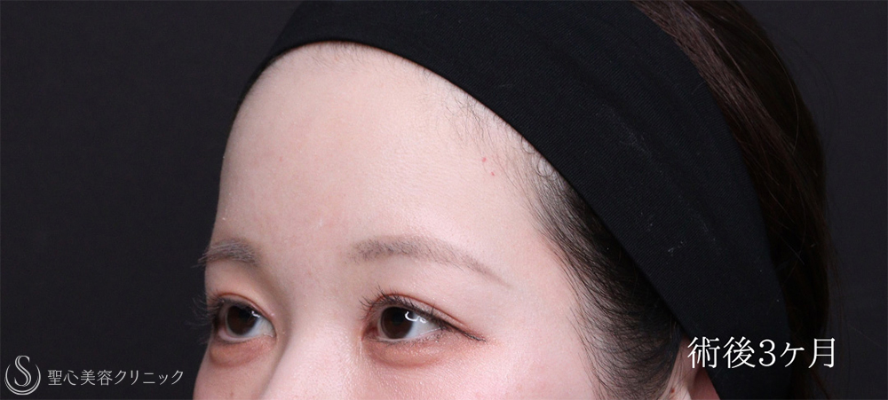 【30代女性・PRPで額を丸く仕上げる】プレミアムPRP皮膚再生療法（3ヶ月後） After 
