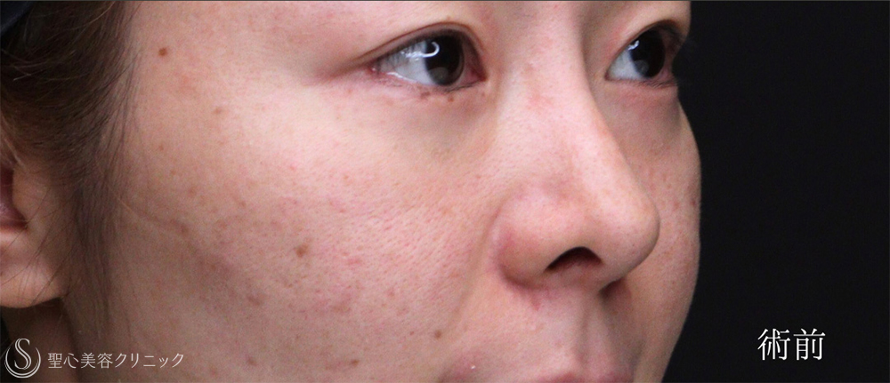 【30代女性・他院修正で鼻の穴を目立ちにくく】鼻孔縁下降術＋小鼻縮小（3ヶ月後） Before 