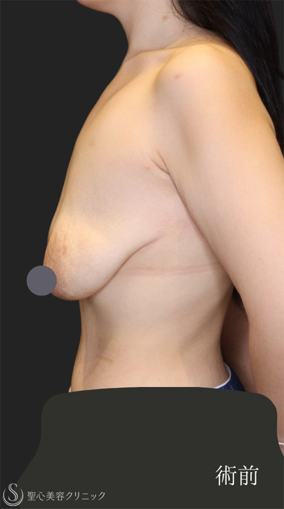 【20代女性・バストの下垂を修正】 乳房吊り上げ術（マストペクシー）（1ヶ月後） Before 