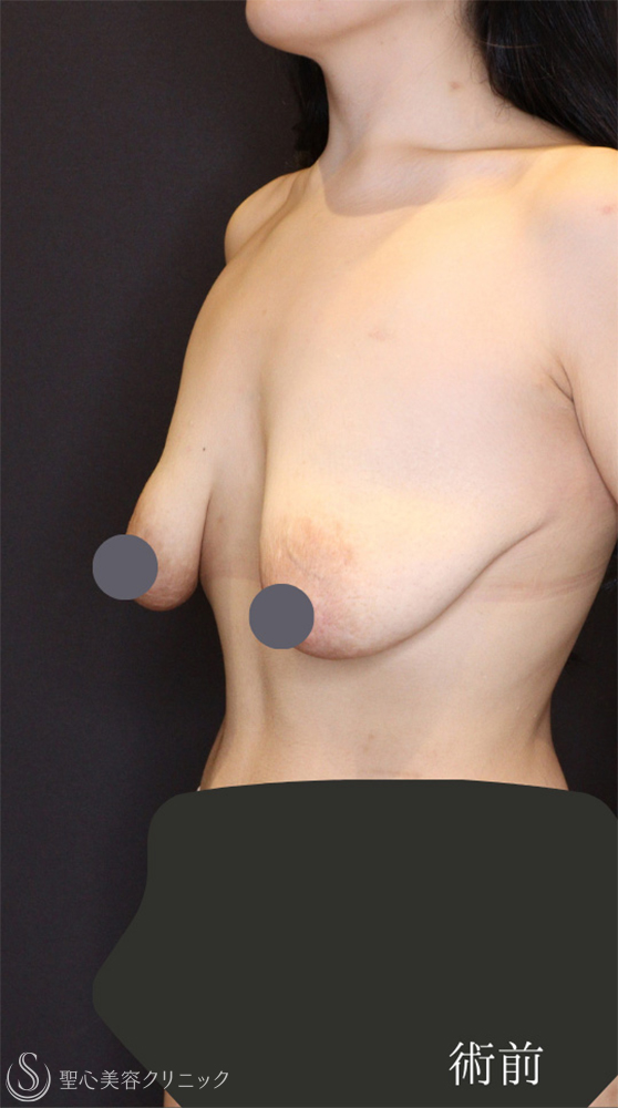 【20代女性・バストの下垂を修正】 乳房吊り上げ術（マストペクシー）（1ヶ月後） Before 
