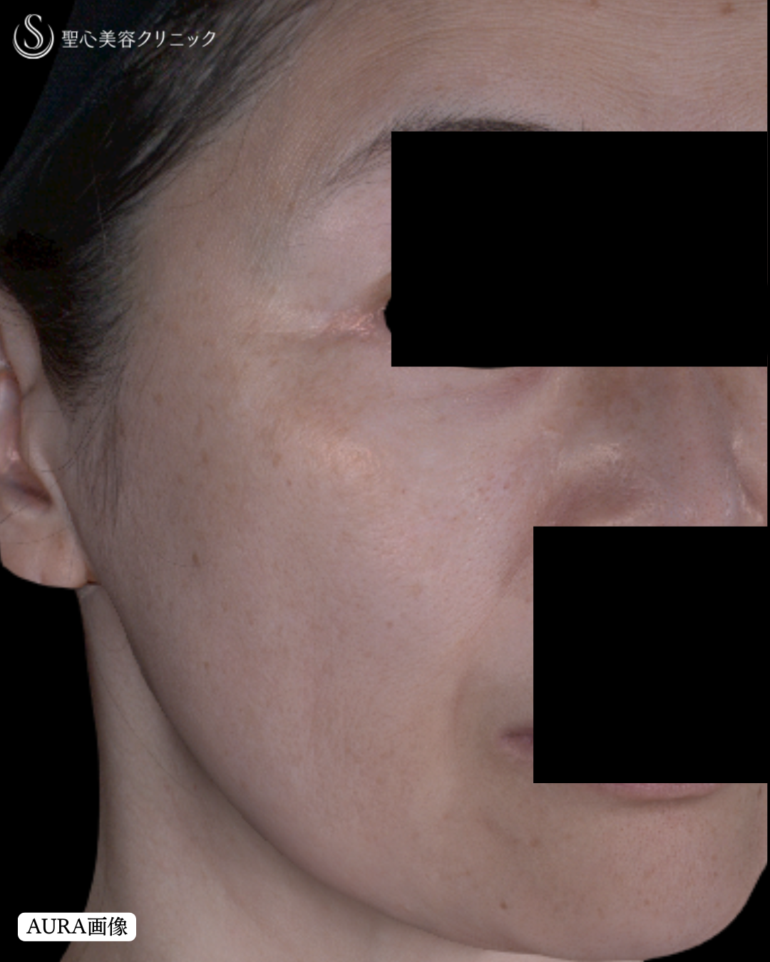 【50代女性・肌質改善】レチノール外用（5ヶ月後） Before 