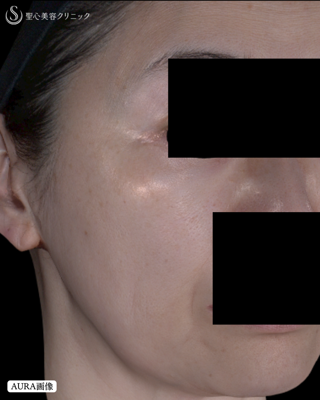 【50代女性・肌質改善】レチノール外用（5ヶ月後） After 