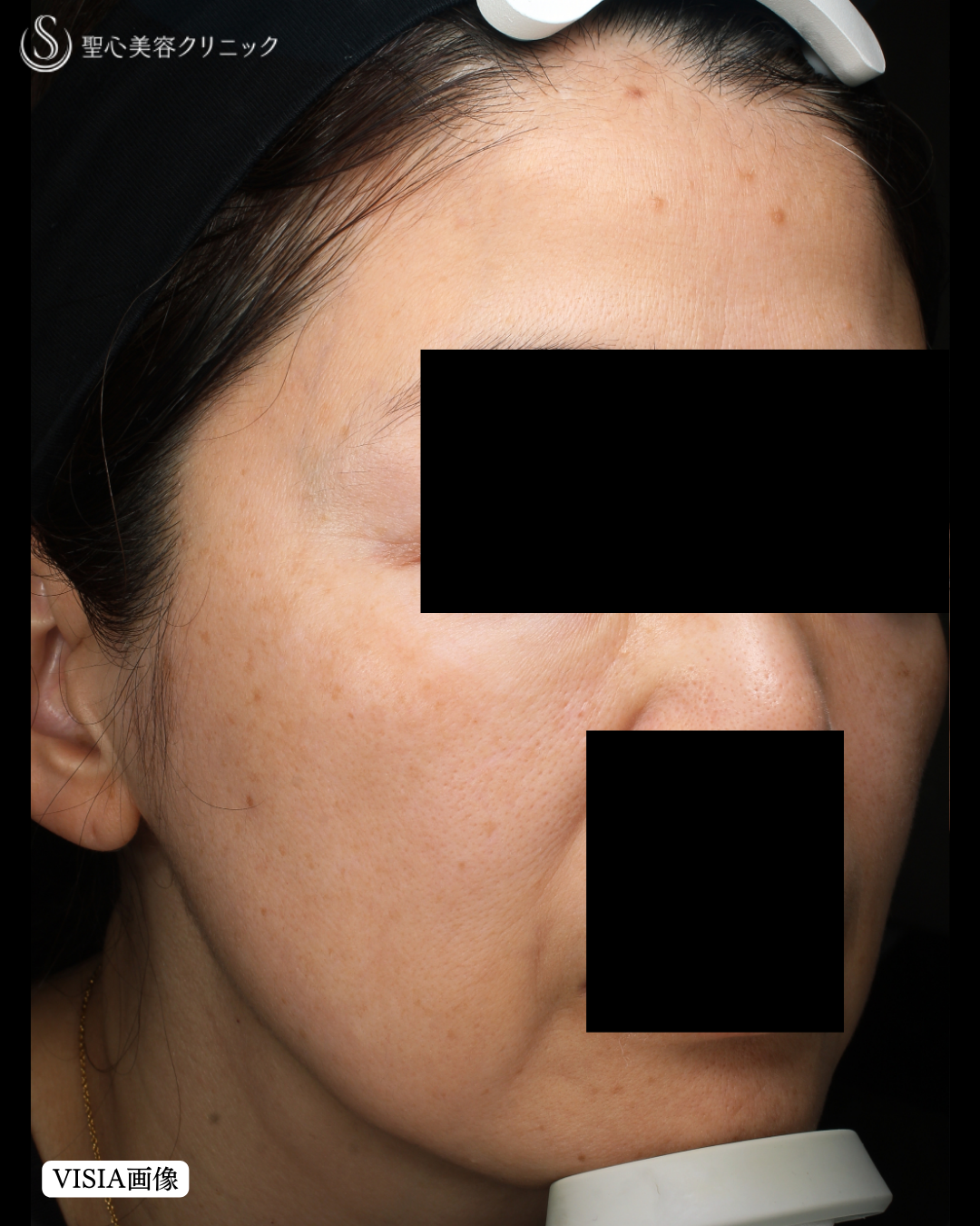 【50代女性・肌質改善】レチノール外用（5ヶ月後） Before 