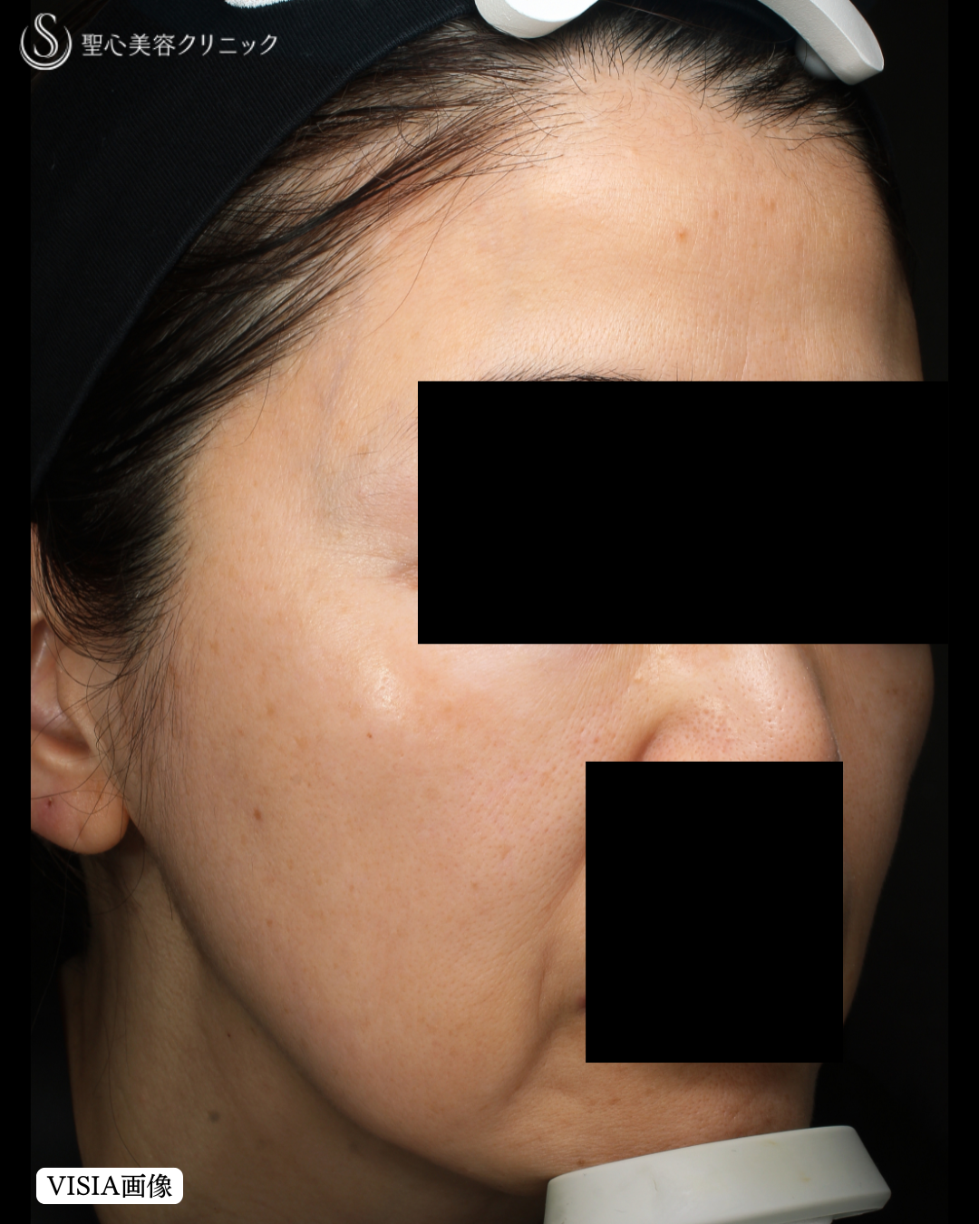 【50代女性・肌質改善】レチノール外用（5ヶ月後） After 