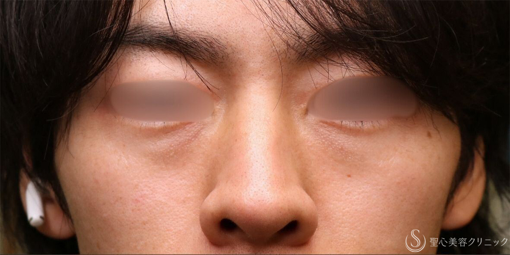 【30代男性・自然な若返り】プレミアムPRP皮膚再生療法（目の下）（1年後） Before 名古屋+目の下のくま　目の下の脂肪取り