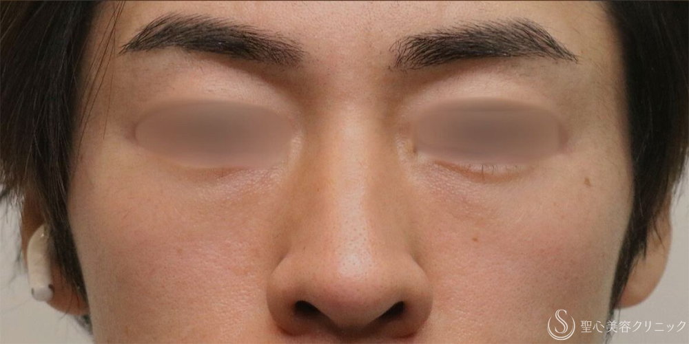 【30代男性・自然な若返り】プレミアムPRP皮膚再生療法（目の下）（1年後） After 名古屋+目の下のくま　目の下の脂肪取り