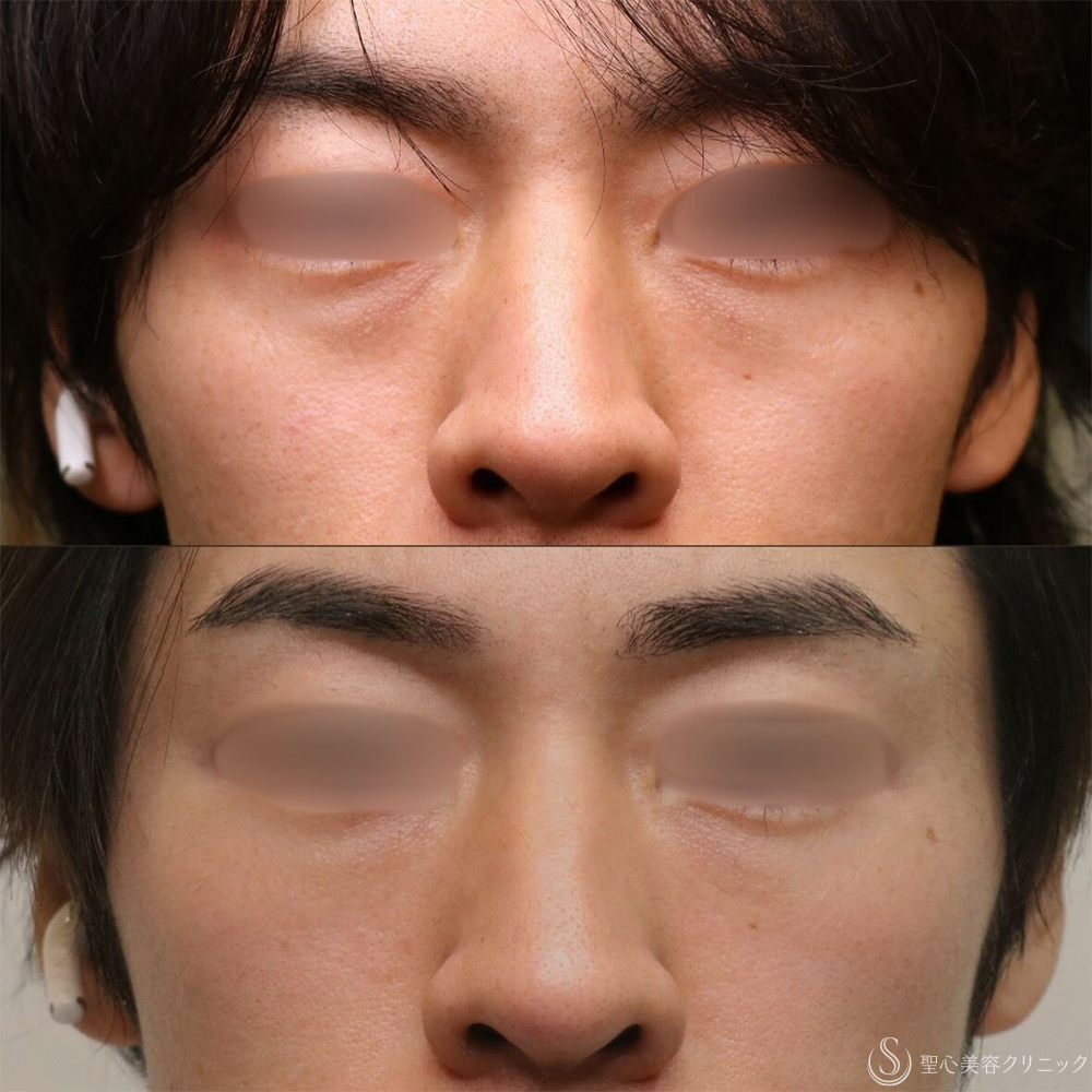 【30代男性・自然な若返り】プレミアムPRP皮膚再生療法（目の下）（1年後） After 名古屋+目の下のくま　目の下の脂肪取り