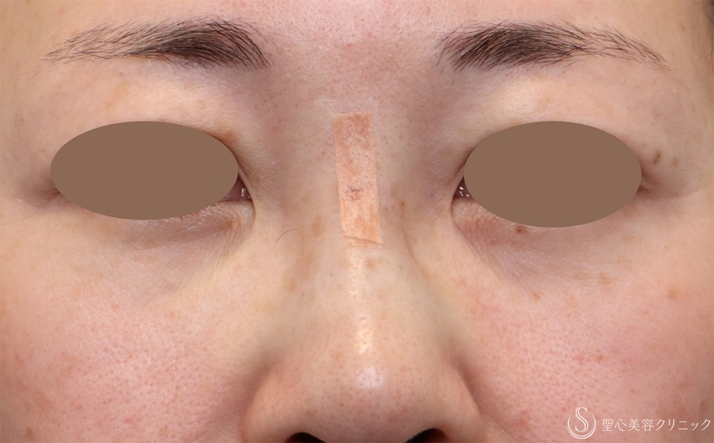 【40代女性・太くなった鼻根修正】鼻アクアミド除去（直後） After 