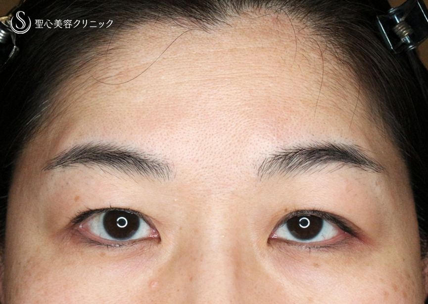【49歳女性・重度のコンタクトレンズ眼瞼下垂】切らない眼瞼下垂+α法（術直後〜3ヶ月後） After 