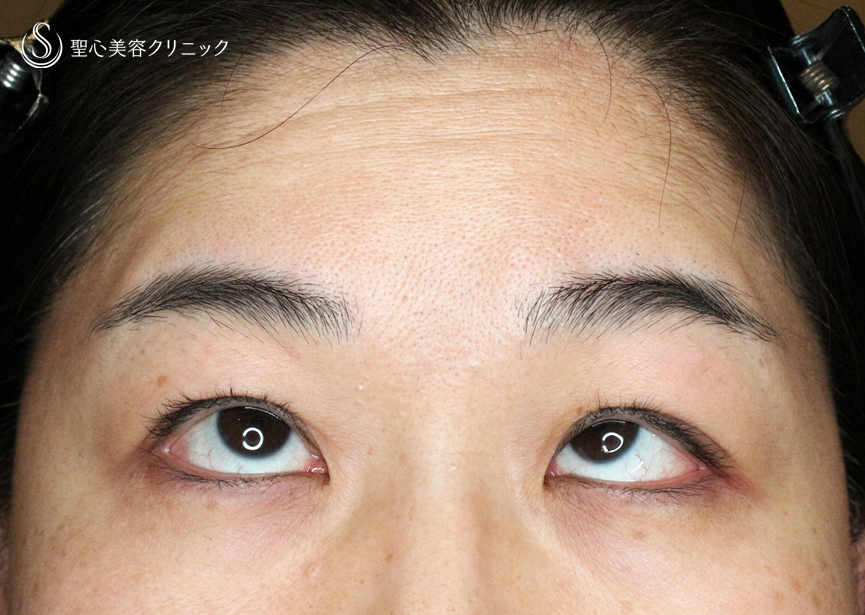 【49歳女性・重度のコンタクトレンズ眼瞼下垂】切らない眼瞼下垂+α法（術直後〜3ヶ月後） After 
