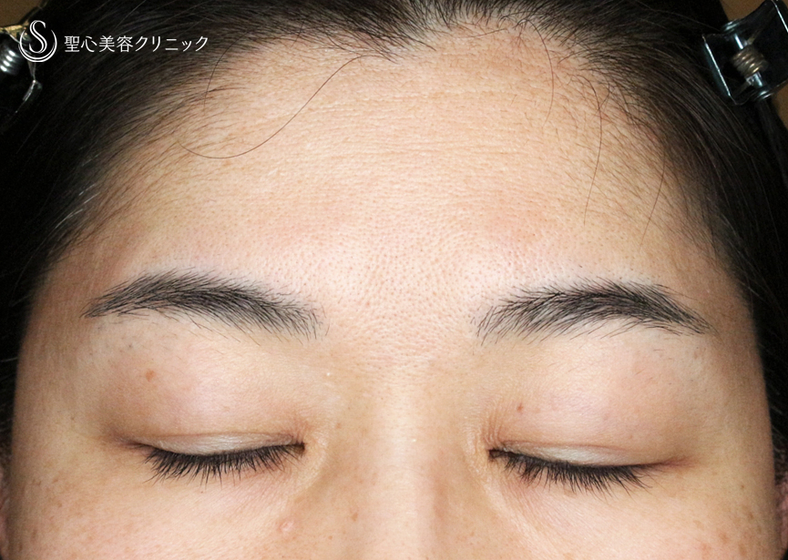 【49歳女性・重度のコンタクトレンズ眼瞼下垂】切らない眼瞼下垂+α法（術直後〜3ヶ月後） After 