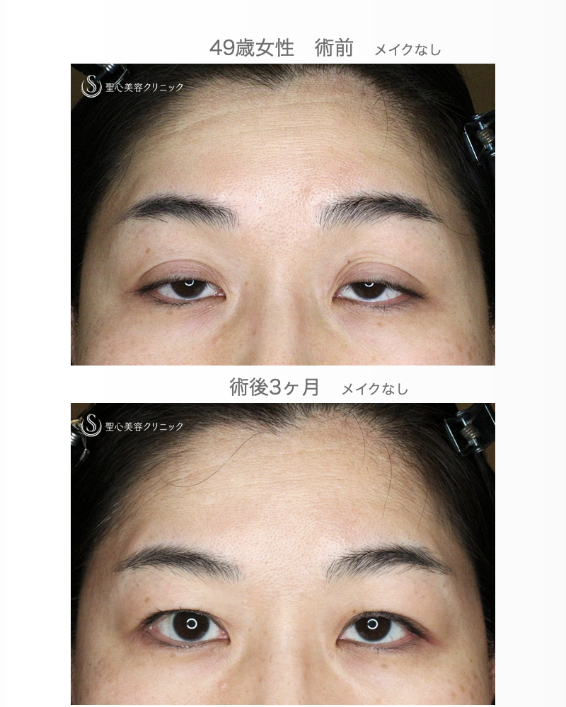 【49歳女性・重度のコンタクトレンズ眼瞼下垂】切らない眼瞼下垂+α法（術直後〜3ヶ月後） After 