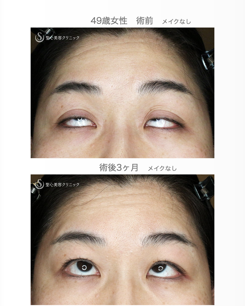 【49歳女性・重度のコンタクトレンズ眼瞼下垂】切らない眼瞼下垂+α法（術直後〜3ヶ月後） After 