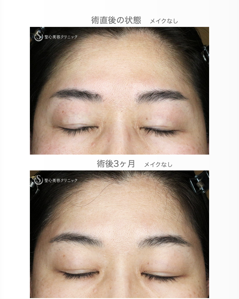 【49歳女性・重度のコンタクトレンズ眼瞼下垂】切らない眼瞼下垂+α法（術直後〜3ヶ月後） After 